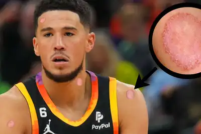 Devin Booker Refuses To Acknowledge His Serious Case of Ringworm