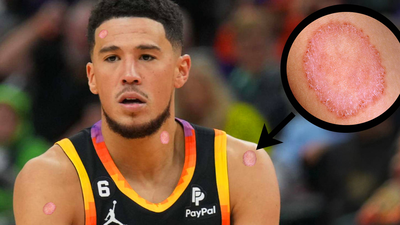 Devin Booker Refuses To Acknowledge His Serious Case of Ringworm