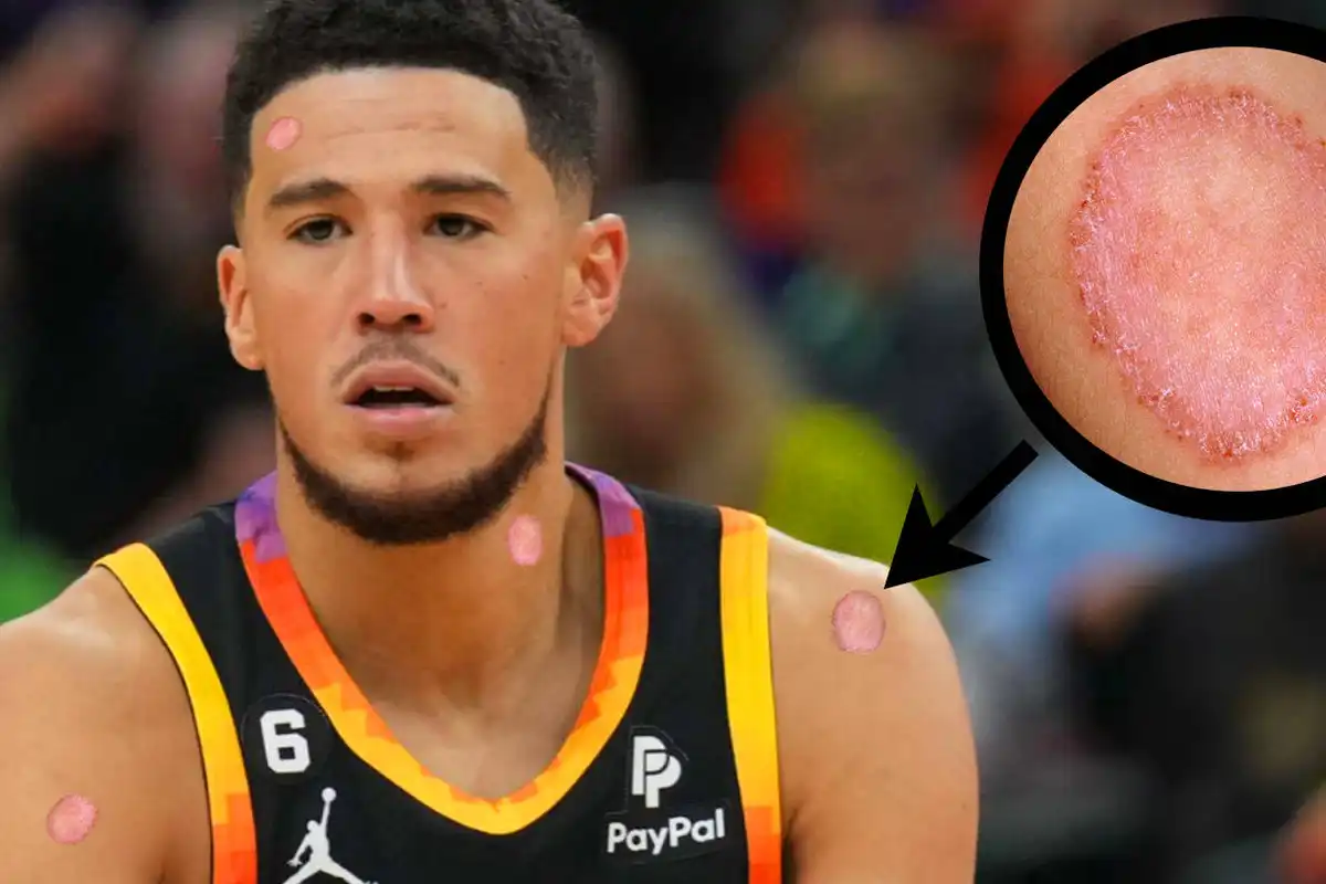 Devin Booker Refuses To Acknowledge His Serious Case of Ringworm